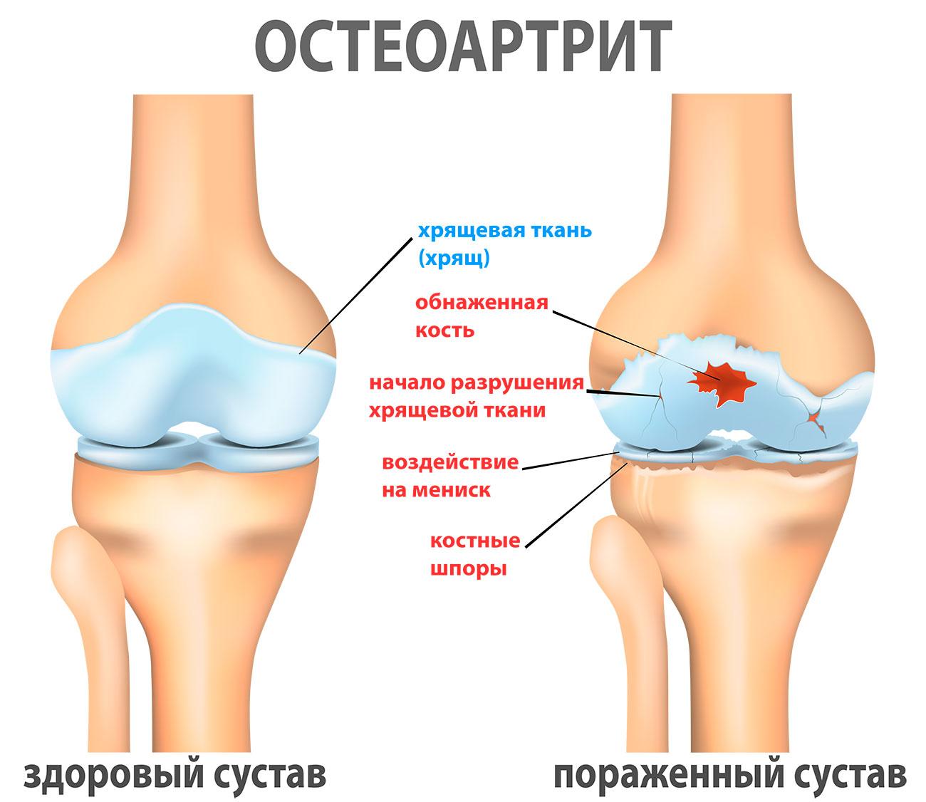 Остеоартрит картинка здоровый сустав и пораженный сустав