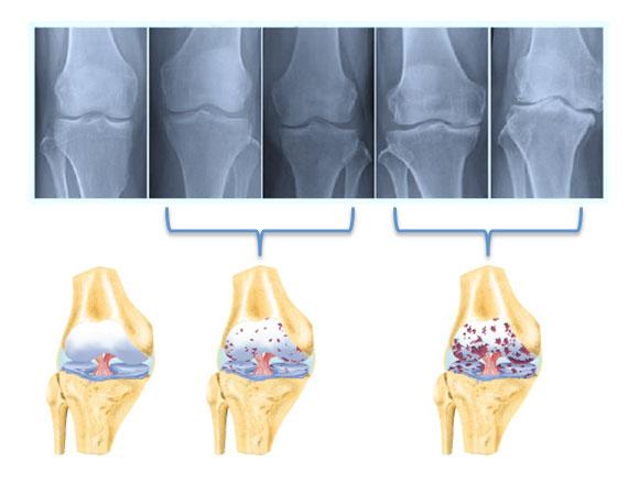 4 стадии артроза суставов рентген и рисунок