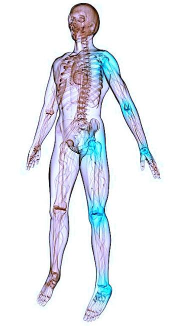 Остеоратрит может влиять на все суставы тела - РенехаВис